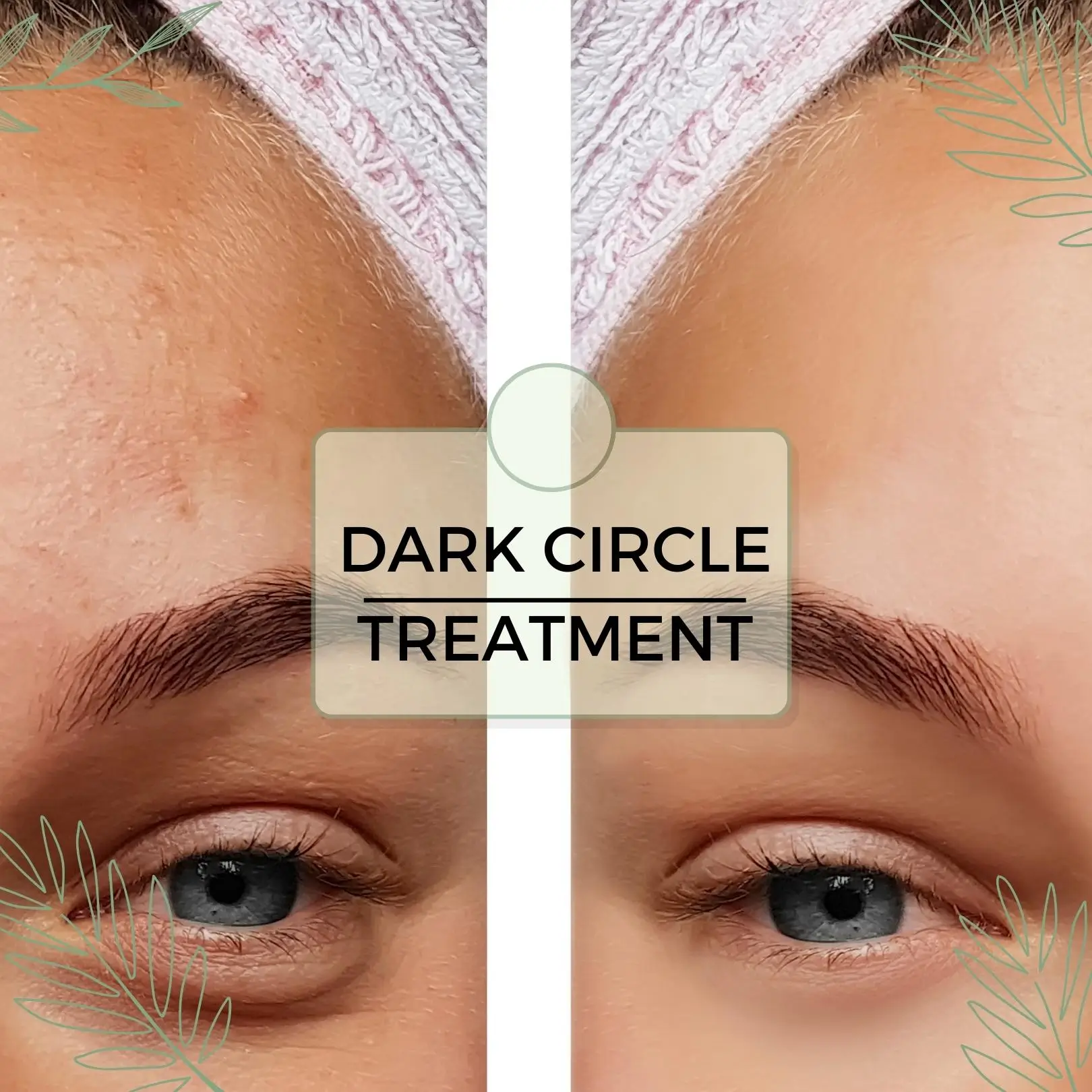 Dark Circle Treatment