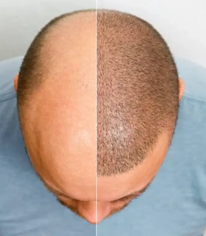 Hair Transplant