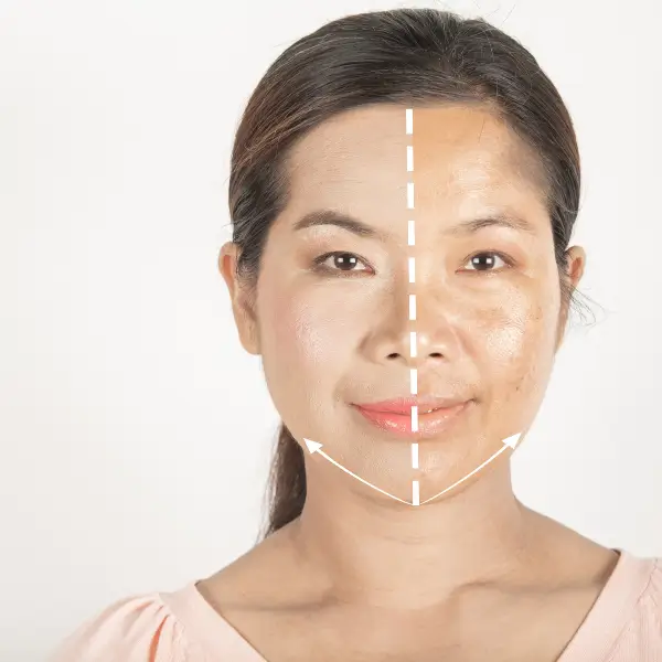 Melasma Treatment